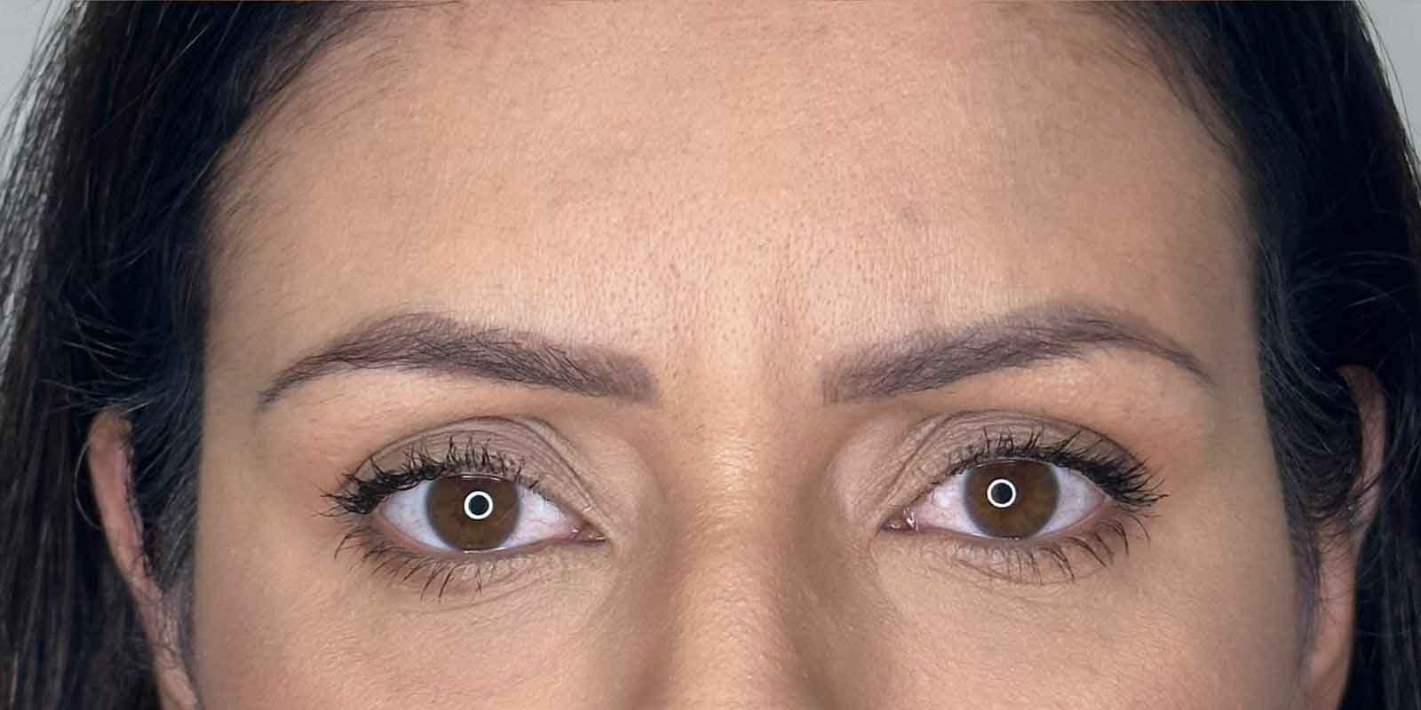 botox-e-2